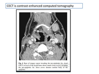 radiographic technique of oral tumors.pptx