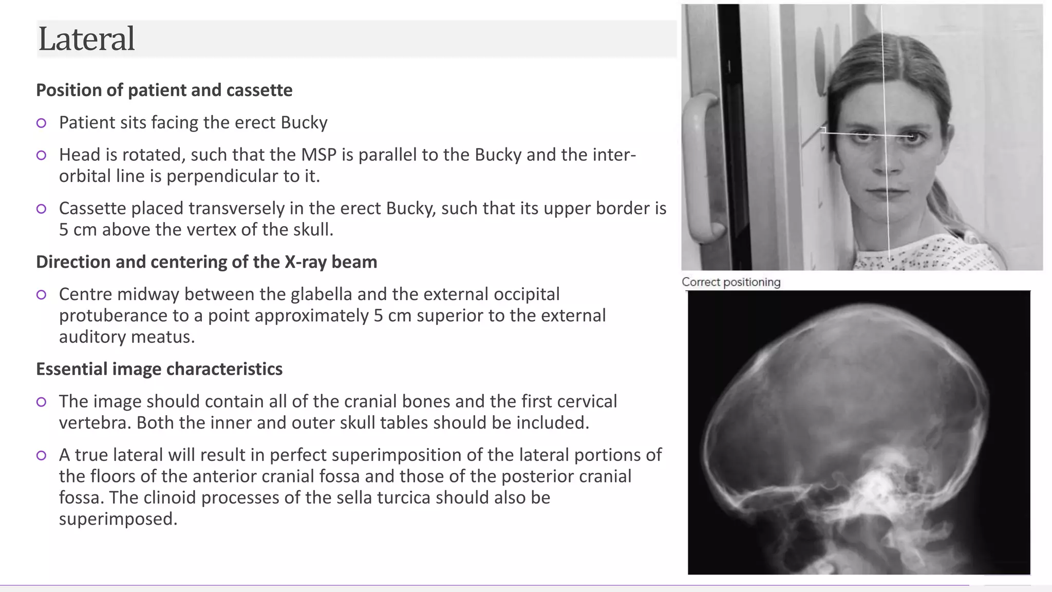 Contoso Ltd.
Position of patient and cassette
○ Patient sits facing the erect Bucky
○ Head is rotated, such that the MSP is parallel to the Bucky and the inter-
orbital line is perpendicular to it.
○ Cassette placed transversely in the erect Bucky, such that its upper border is
5 cm above the vertex of the skull.
Direction and centering of the X-ray beam
○ Centre midway between the glabella and the external occipital
protuberance to a point approximately 5 cm superior to the external
auditory meatus.
Essential image characteristics
○ The image should contain all of the cranial bones and the first cervical
vertebra. Both the inner and outer skull tables should be included.
○ A true lateral will result in perfect superimposition of the lateral portions of
the floors of the anterior cranial fossa and those of the posterior cranial
fossa. The clinoid processes of the sella turcica should also be
superimposed.
10
Lateral
 
