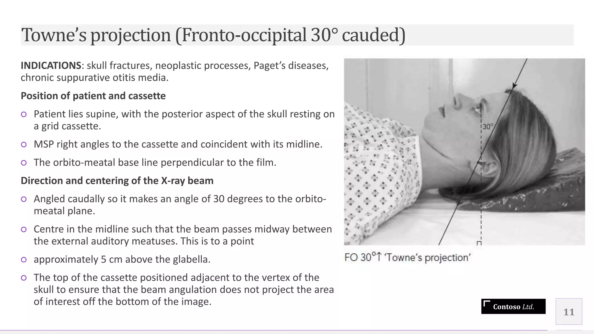Contoso Ltd.
INDICATIONS: skull fractures, neoplastic processes, Paget’s diseases,
chronic suppurative otitis media.
Position of patient and cassette
○ Patient lies supine, with the posterior aspect of the skull resting on
a grid cassette.
○ MSP right angles to the cassette and coincident with its midline.
○ The orbito-meatal base line perpendicular to the film.
Direction and centering of the X-ray beam
○ Angled caudally so it makes an angle of 30 degrees to the orbito-
meatal plane.
○ Centre in the midline such that the beam passes midway between
the external auditory meatuses. This is to a point
○ approximately 5 cm above the glabella.
○ The top of the cassette positioned adjacent to the vertex of the
skull to ensure that the beam angulation does not project the area
of interest off the bottom of the image.
11
Towne’sprojection(Fronto-occipital30° cauded)
 
