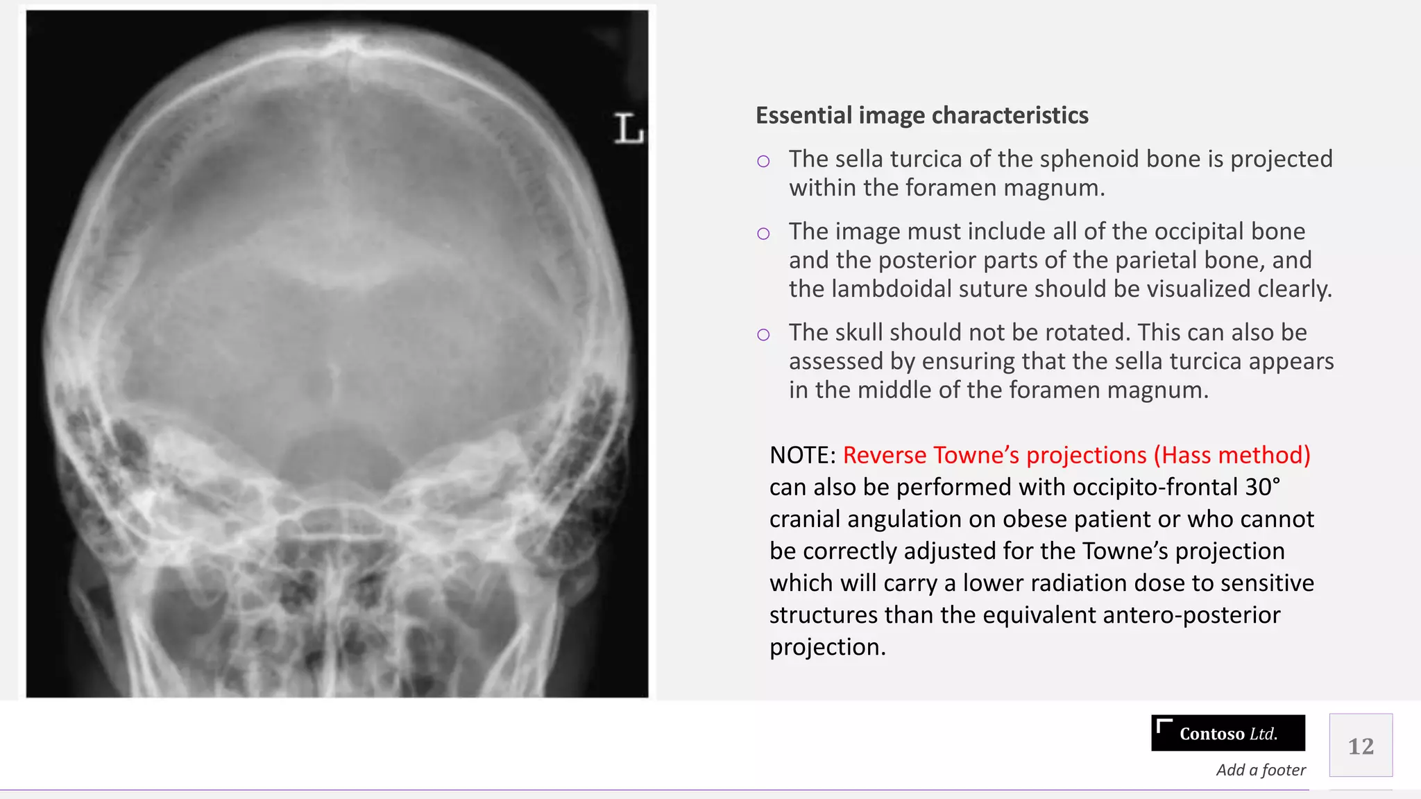 Contoso Ltd.
Essential image characteristics
o The sella turcica of the sphenoid bone is projected
within the foramen magnum.
o The image must include all of the occipital bone
and the posterior parts of the parietal bone, and
the lambdoidal suture should be visualized clearly.
o The skull should not be rotated. This can also be
assessed by ensuring that the sella turcica appears
in the middle of the foramen magnum.
12
Add a footer
NOTE: Reverse Towne’s projections (Hass method)
can also be performed with occipito-frontal 30°
cranial angulation on obese patient or who cannot
be correctly adjusted for the Towne’s projection
which will carry a lower radiation dose to sensitive
structures than the equivalent antero-posterior
projection.
 