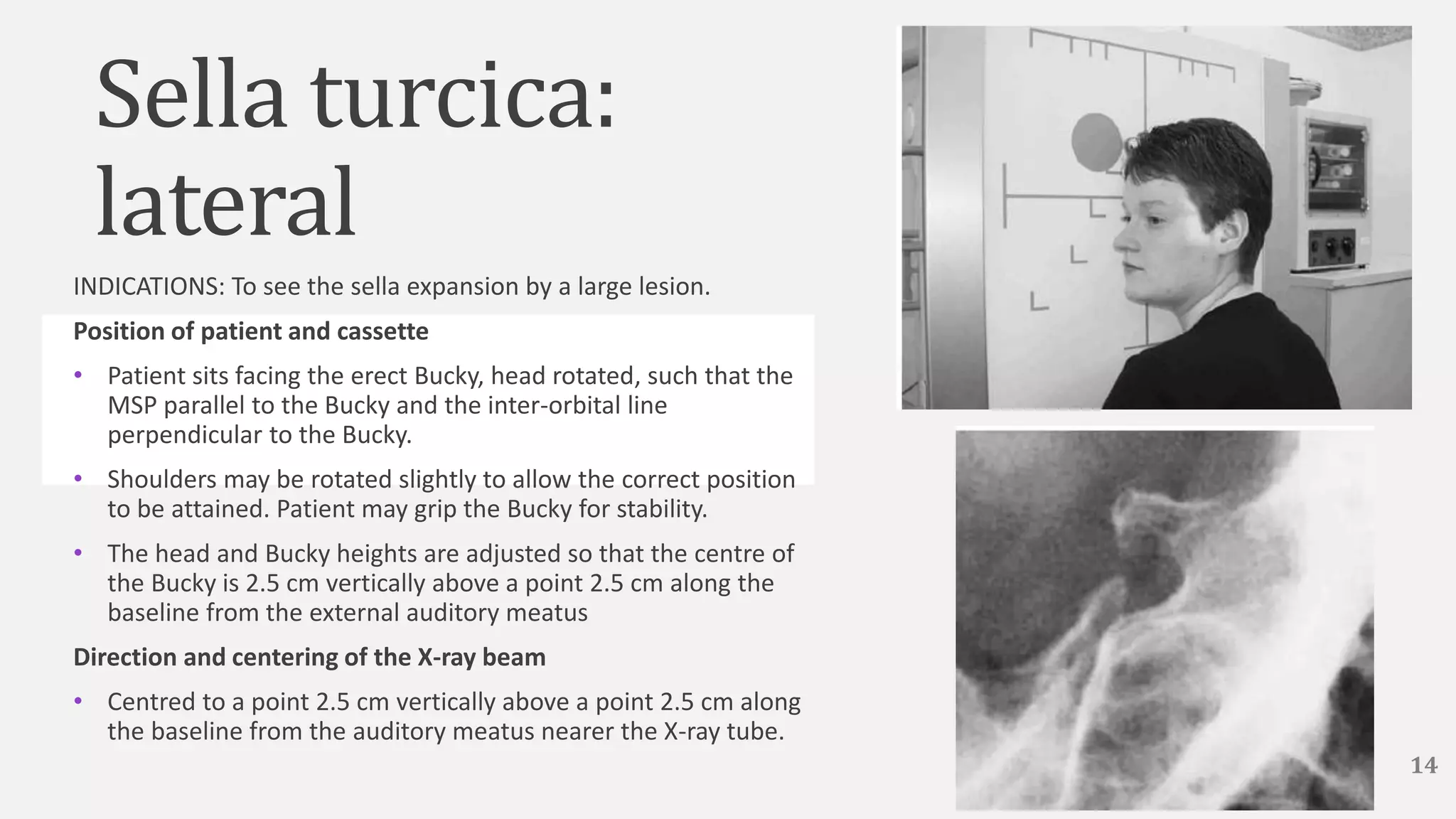Sella turcica:
lateral
INDICATIONS: To see the sella expansion by a large lesion.
Position of patient and cassette
• Patient sits facing the erect Bucky, head rotated, such that the
MSP parallel to the Bucky and the inter-orbital line
perpendicular to the Bucky.
• Shoulders may be rotated slightly to allow the correct position
to be attained. Patient may grip the Bucky for stability.
• The head and Bucky heights are adjusted so that the centre of
the Bucky is 2.5 cm vertically above a point 2.5 cm along the
baseline from the external auditory meatus
Direction and centering of the X-ray beam
• Centred to a point 2.5 cm vertically above a point 2.5 cm along
the baseline from the auditory meatus nearer the X-ray tube.
14
 