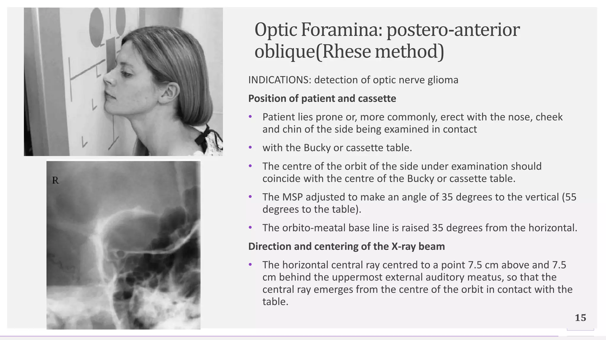Contoso Ltd.
OpticForamina:postero-anterior
oblique(Rhesemethod)
15
INDICATIONS: detection of optic nerve glioma
Position of patient and cassette
• Patient lies prone or, more commonly, erect with the nose, cheek
and chin of the side being examined in contact
• with the Bucky or cassette table.
• The centre of the orbit of the side under examination should
coincide with the centre of the Bucky or cassette table.
• The MSP adjusted to make an angle of 35 degrees to the vertical (55
degrees to the table).
• The orbito-meatal base line is raised 35 degrees from the horizontal.
Direction and centering of the X-ray beam
• The horizontal central ray centred to a point 7.5 cm above and 7.5
cm behind the uppermost external auditory meatus, so that the
central ray emerges from the centre of the orbit in contact with the
table.
 