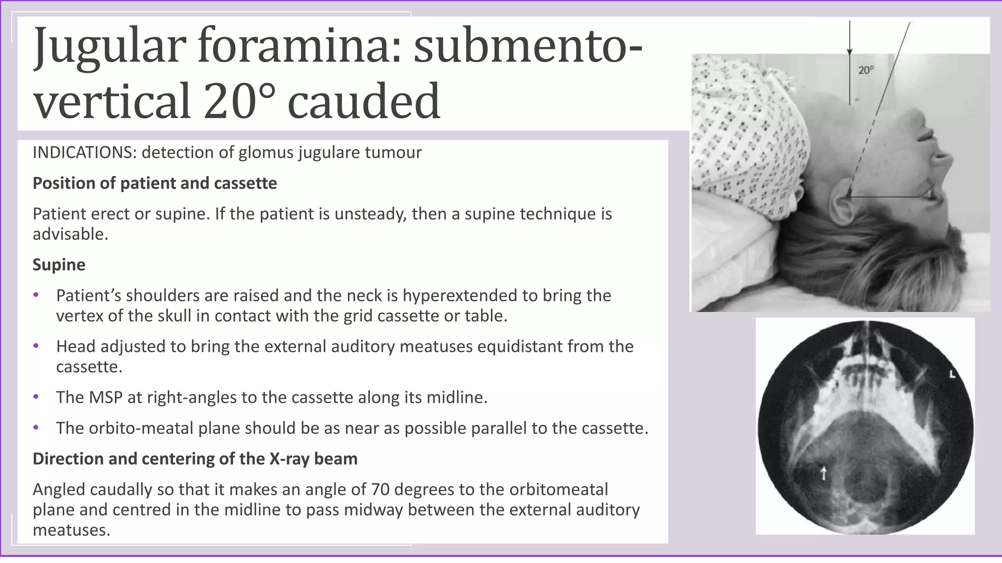 Jugular foramina: submento-
vertical 20° cauded
INDICATIONS: detection of glomus jugulare tumour
Position of patient and cassette
Patient erect or supine. If the patient is unsteady, then a supine technique is
advisable.
Supine
• Patient’s shoulders are raised and the neck is hyperextended to bring the
vertex of the skull in contact with the grid cassette or table.
• Head adjusted to bring the external auditory meatuses equidistant from the
cassette.
• The MSP at right-angles to the cassette along its midline.
• The orbito-meatal plane should be as near as possible parallel to the cassette.
Direction and centering of the X-ray beam
Angled caudally so that it makes an angle of 70 degrees to the orbitomeatal
plane and centred in the midline to pass midway between the external auditory
meatuses.
 