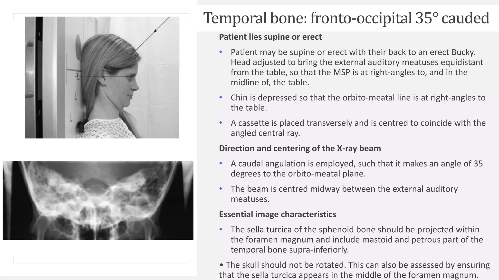 Contoso Ltd.
Temporal bone: fronto-occipital35° cauded
Patient lies supine or erect
• Patient may be supine or erect with their back to an erect Bucky.
Head adjusted to bring the external auditory meatuses equidistant
from the table, so that the MSP is at right-angles to, and in the
midline of, the table.
• Chin is depressed so that the orbito-meatal line is at right-angles to
the table.
• A cassette is placed transversely and is centred to coincide with the
angled central ray.
Direction and centering of the X-ray beam
• A caudal angulation is employed, such that it makes an angle of 35
degrees to the orbito-meatal plane.
• The beam is centred midway between the external auditory
meatuses.
Essential image characteristics
• The sella turcica of the sphenoid bone should be projected within
the foramen magnum and include mastoid and petrous part of the
temporal bone supra-inferiorly.
• The skull should not be rotated. This can also be assessed by ensuring
that the sella turcica appears in the middle of the foramen magnum.
 