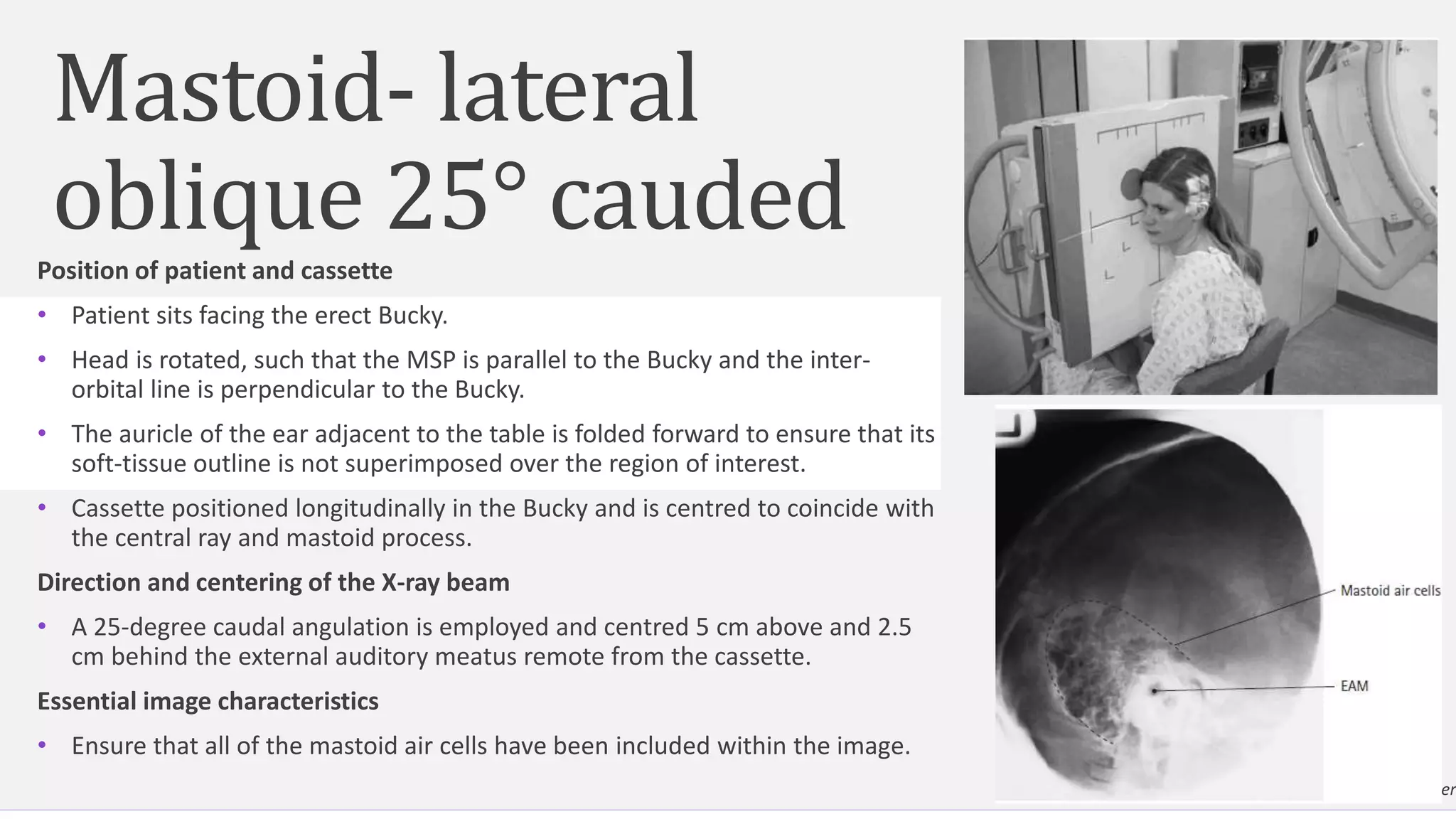 Mastoid- lateral
oblique 25° cauded
Position of patient and cassette
• Patient sits facing the erect Bucky.
• Head is rotated, such that the MSP is parallel to the Bucky and the inter-
orbital line is perpendicular to the Bucky.
• The auricle of the ear adjacent to the table is folded forward to ensure that its
soft-tissue outline is not superimposed over the region of interest.
• Cassette positioned longitudinally in the Bucky and is centred to coincide with
the central ray and mastoid process.
Direction and centering of the X-ray beam
• A 25-degree caudal angulation is employed and centred 5 cm above and 2.5
cm behind the external auditory meatus remote from the cassette.
Essential image characteristics
• Ensure that all of the mastoid air cells have been included within the image.
18
Add a footer
 