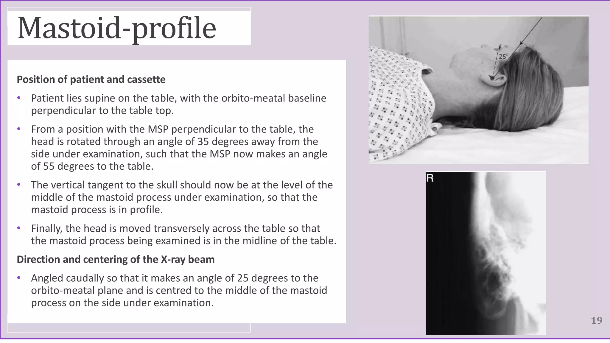 Mastoid-profile
Position of patient and cassette
• Patient lies supine on the table, with the orbito-meatal baseline
perpendicular to the table top.
• From a position with the MSP perpendicular to the table, the
head is rotated through an angle of 35 degrees away from the
side under examination, such that the MSP now makes an angle
of 55 degrees to the table.
• The vertical tangent to the skull should now be at the level of the
middle of the mastoid process under examination, so that the
mastoid process is in profile.
• Finally, the head is moved transversely across the table so that
the mastoid process being examined is in the midline of the table.
Direction and centering of the X-ray beam
• Angled caudally so that it makes an angle of 25 degrees to the
orbito-meatal plane and is centred to the middle of the mastoid
process on the side under examination.
19
 