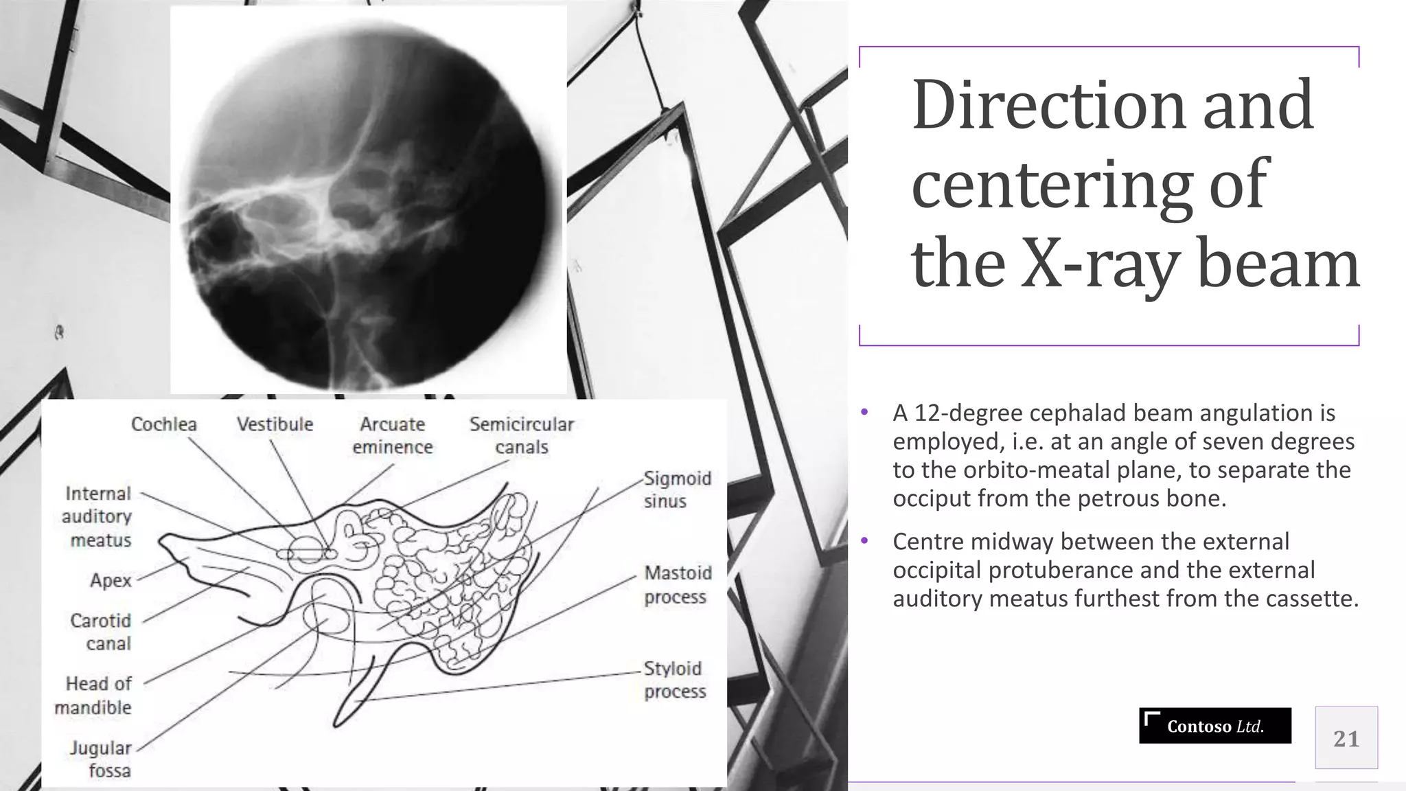 Contoso Ltd.
Direction and
centering of
the X-ray beam
• A 12-degree cephalad beam angulation is
employed, i.e. at an angle of seven degrees
to the orbito-meatal plane, to separate the
occiput from the petrous bone.
• Centre midway between the external
occipital protuberance and the external
auditory meatus furthest from the cassette.
21
 