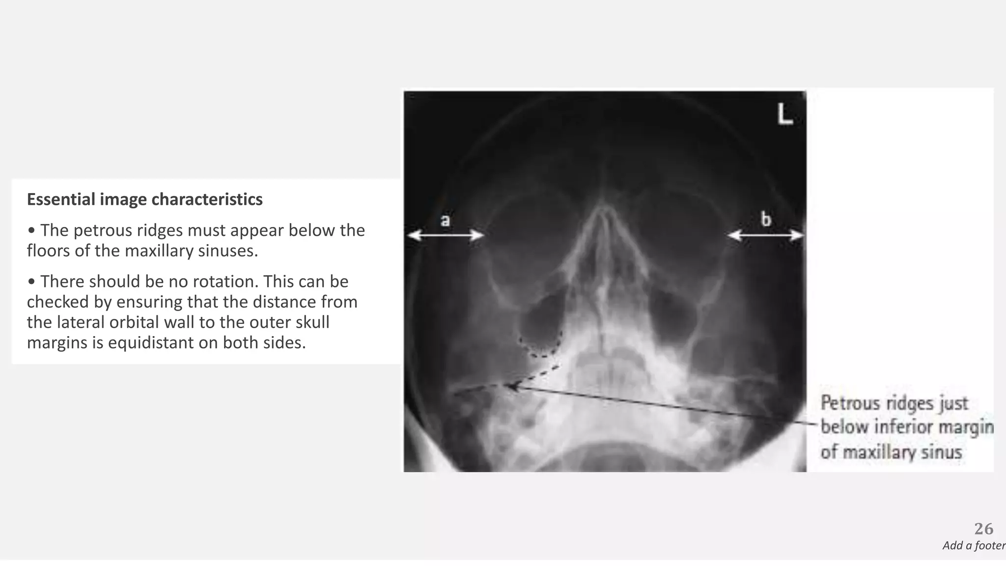 Essential image characteristics
• The petrous ridges must appear below the
floors of the maxillary sinuses.
• There should be no rotation. This can be
checked by ensuring that the distance from
the lateral orbital wall to the outer skull
margins is equidistant on both sides.
26
Add a footer
 