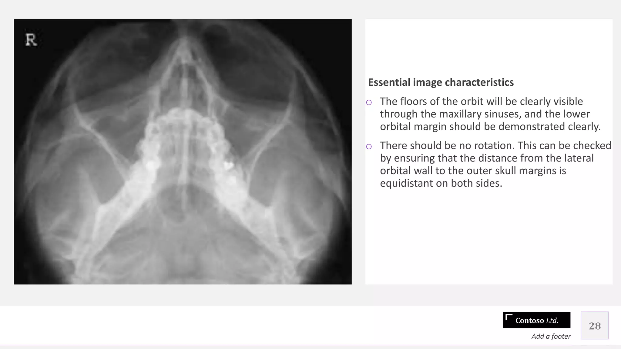 Contoso Ltd.
Essential image characteristics
o The floors of the orbit will be clearly visible
through the maxillary sinuses, and the lower
orbital margin should be demonstrated clearly.
o There should be no rotation. This can be checked
by ensuring that the distance from the lateral
orbital wall to the outer skull margins is
equidistant on both sides.
28
Add a footer
 