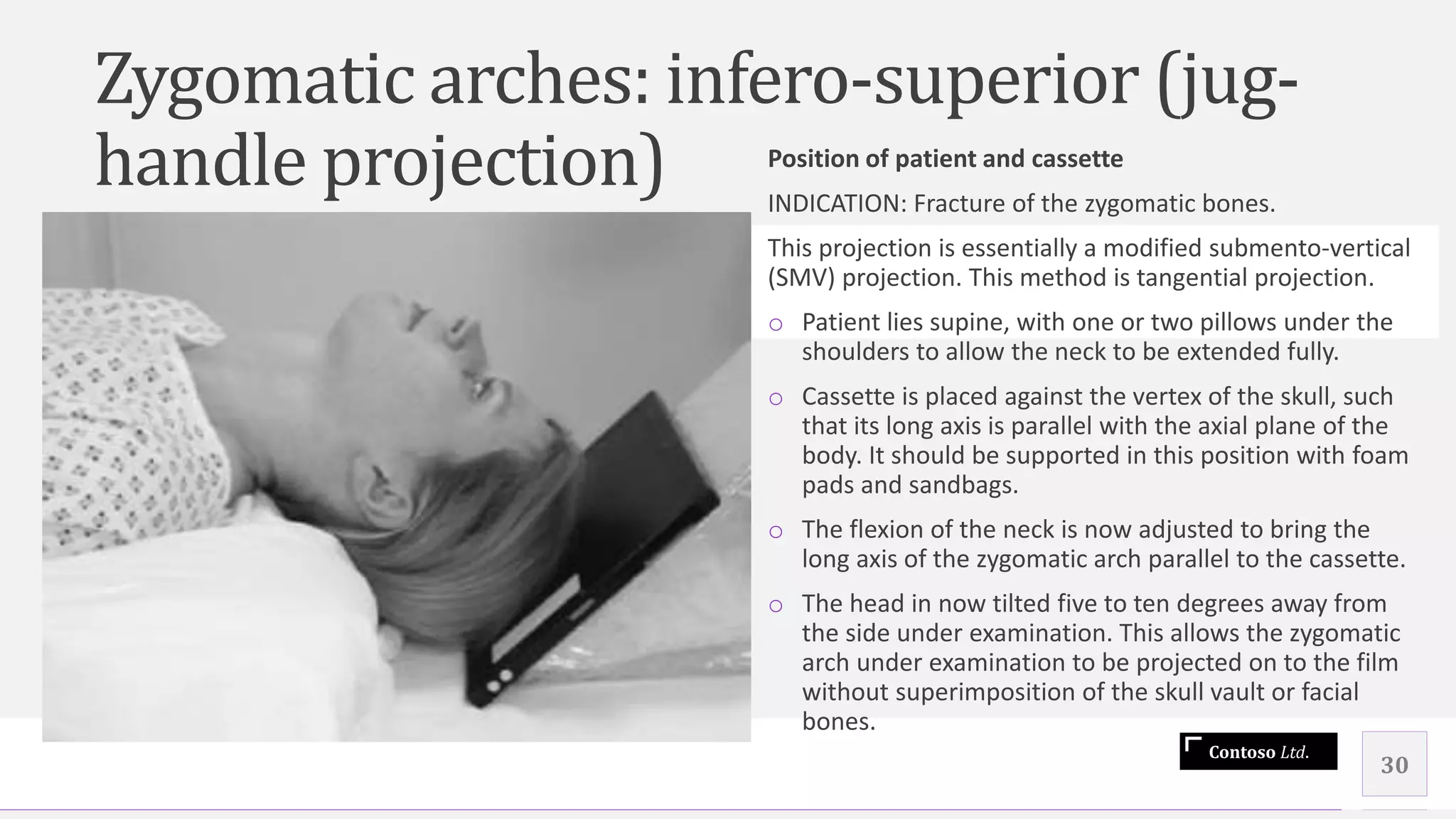 Contoso Ltd.
Zygomatic arches: infero-superior (jug-
handle projection) Position of patient and cassette
INDICATION: Fracture of the zygomatic bones.
This projection is essentially a modified submento-vertical
(SMV) projection. This method is tangential projection.
o Patient lies supine, with one or two pillows under the
shoulders to allow the neck to be extended fully.
o Cassette is placed against the vertex of the skull, such
that its long axis is parallel with the axial plane of the
body. It should be supported in this position with foam
pads and sandbags.
o The flexion of the neck is now adjusted to bring the
long axis of the zygomatic arch parallel to the cassette.
o The head in now tilted five to ten degrees away from
the side under examination. This allows the zygomatic
arch under examination to be projected on to the film
without superimposition of the skull vault or facial
bones.
30
 