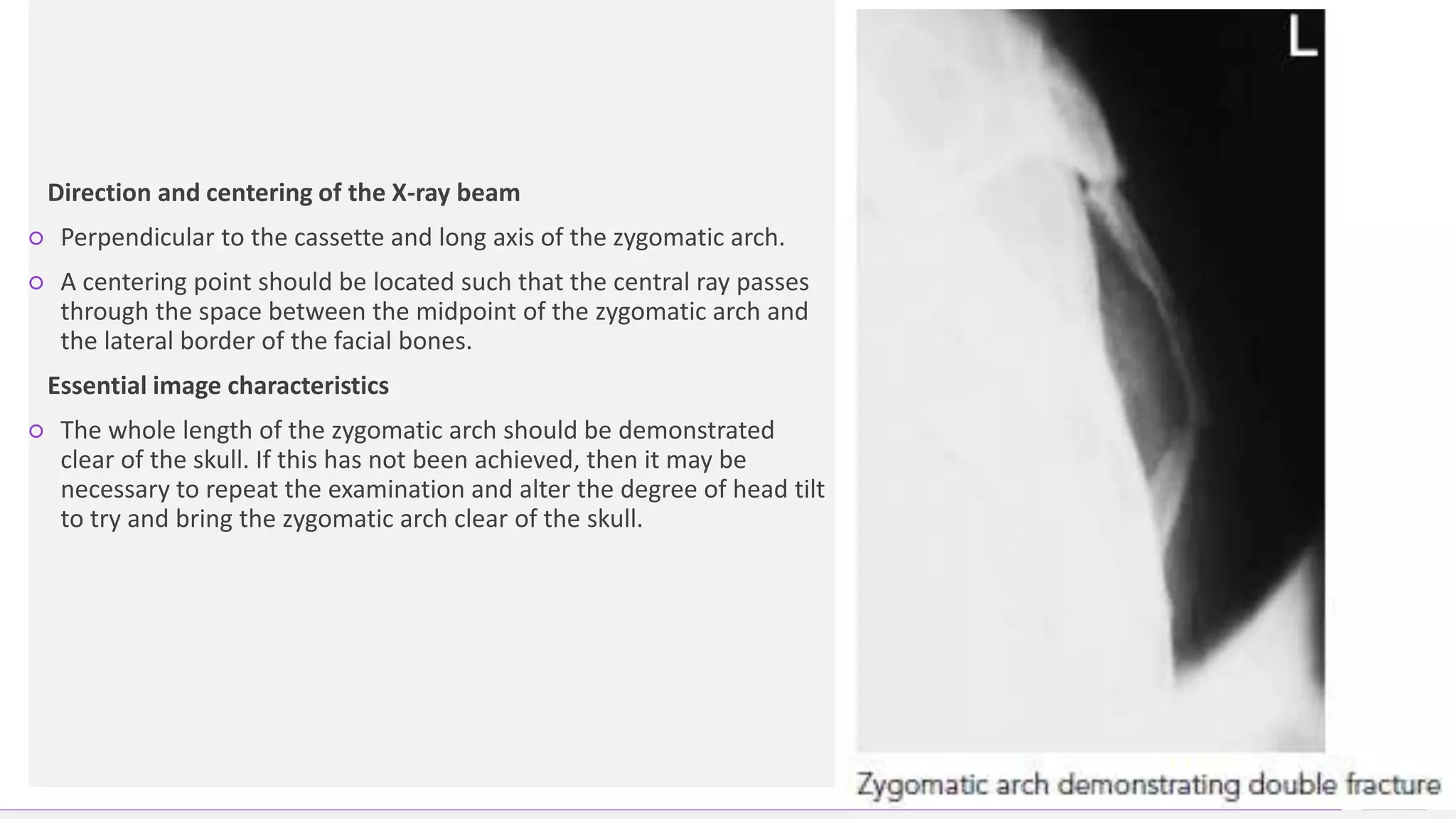 Contoso Ltd.
Direction and centering of the X-ray beam
○ Perpendicular to the cassette and long axis of the zygomatic arch.
○ A centering point should be located such that the central ray passes
through the space between the midpoint of the zygomatic arch and
the lateral border of the facial bones.
Essential image characteristics
○ The whole length of the zygomatic arch should be demonstrated
clear of the skull. If this has not been achieved, then it may be
necessary to repeat the examination and alter the degree of head tilt
to try and bring the zygomatic arch clear of the skull.
31
Add a footer
 