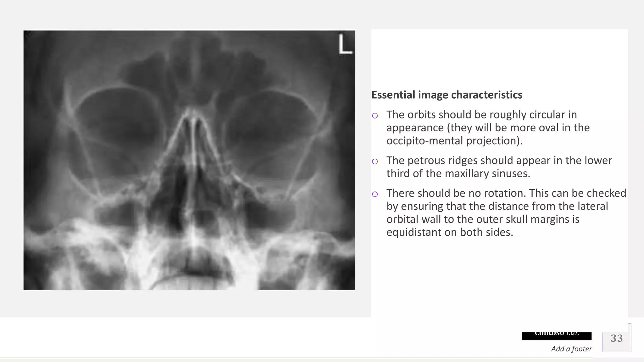 Contoso Ltd.
Essential image characteristics
o The orbits should be roughly circular in
appearance (they will be more oval in the
occipito-mental projection).
o The petrous ridges should appear in the lower
third of the maxillary sinuses.
o There should be no rotation. This can be checked
by ensuring that the distance from the lateral
orbital wall to the outer skull margins is
equidistant on both sides.
33
Add a footer
 