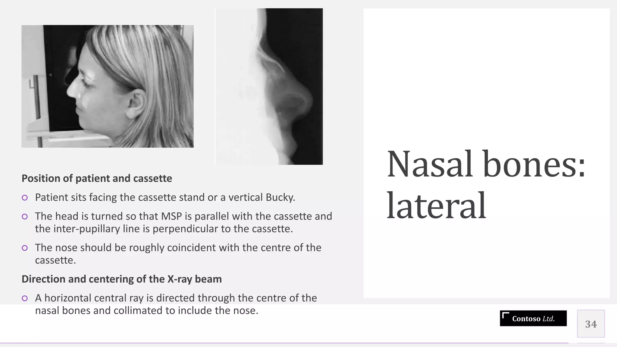 Contoso Ltd.
Nasal bones:
lateral
34
Position of patient and cassette
○ Patient sits facing the cassette stand or a vertical Bucky.
○ The head is turned so that MSP is parallel with the cassette and
the inter-pupillary line is perpendicular to the cassette.
○ The nose should be roughly coincident with the centre of the
cassette.
Direction and centering of the X-ray beam
○ A horizontal central ray is directed through the centre of the
nasal bones and collimated to include the nose.
 