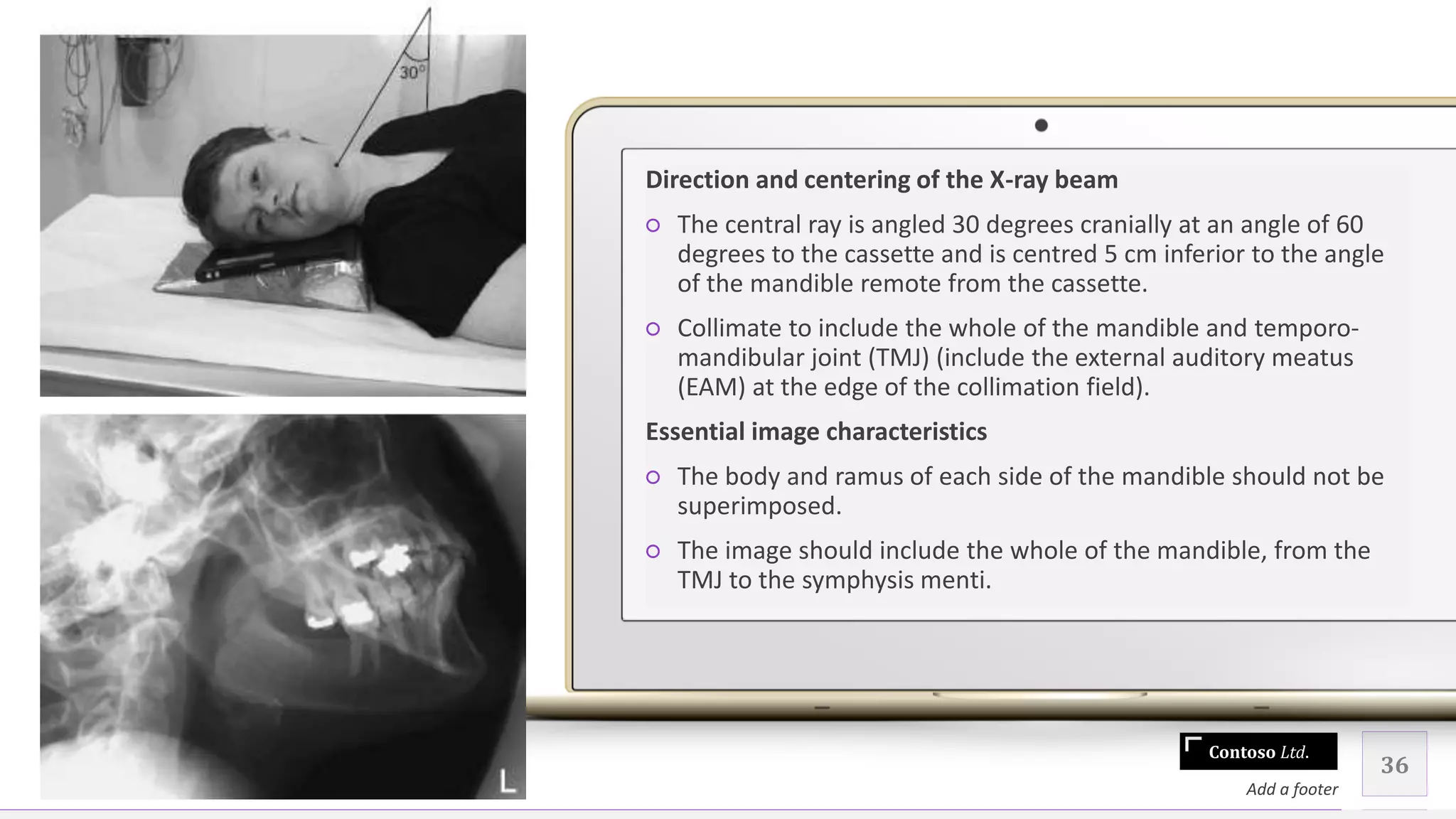 Contoso Ltd.
Direction and centering of the X-ray beam
○ The central ray is angled 30 degrees cranially at an angle of 60
degrees to the cassette and is centred 5 cm inferior to the angle
of the mandible remote from the cassette.
○ Collimate to include the whole of the mandible and temporo-
mandibular joint (TMJ) (include the external auditory meatus
(EAM) at the edge of the collimation field).
Essential image characteristics
○ The body and ramus of each side of the mandible should not be
superimposed.
○ The image should include the whole of the mandible, from the
TMJ to the symphysis menti.
36
Add a footer
 