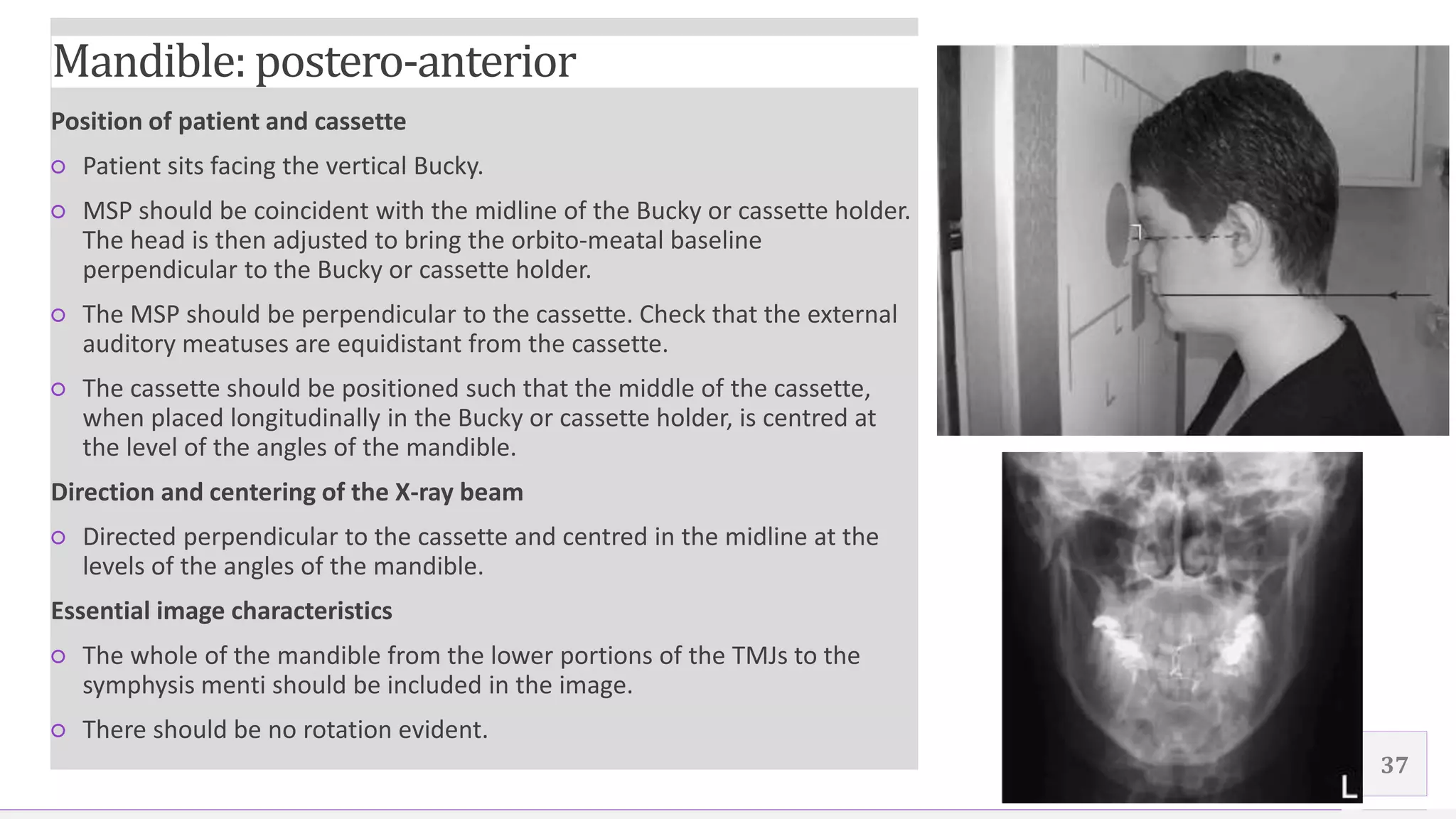 Contoso Ltd.
Position of patient and cassette
○ Patient sits facing the vertical Bucky.
○ MSP should be coincident with the midline of the Bucky or cassette holder.
The head is then adjusted to bring the orbito-meatal baseline
perpendicular to the Bucky or cassette holder.
○ The MSP should be perpendicular to the cassette. Check that the external
auditory meatuses are equidistant from the cassette.
○ The cassette should be positioned such that the middle of the cassette,
when placed longitudinally in the Bucky or cassette holder, is centred at
the level of the angles of the mandible.
Direction and centering of the X-ray beam
○ Directed perpendicular to the cassette and centred in the midline at the
levels of the angles of the mandible.
Essential image characteristics
○ The whole of the mandible from the lower portions of the TMJs to the
symphysis menti should be included in the image.
○ There should be no rotation evident.
37
Mandible: postero-anterior
 