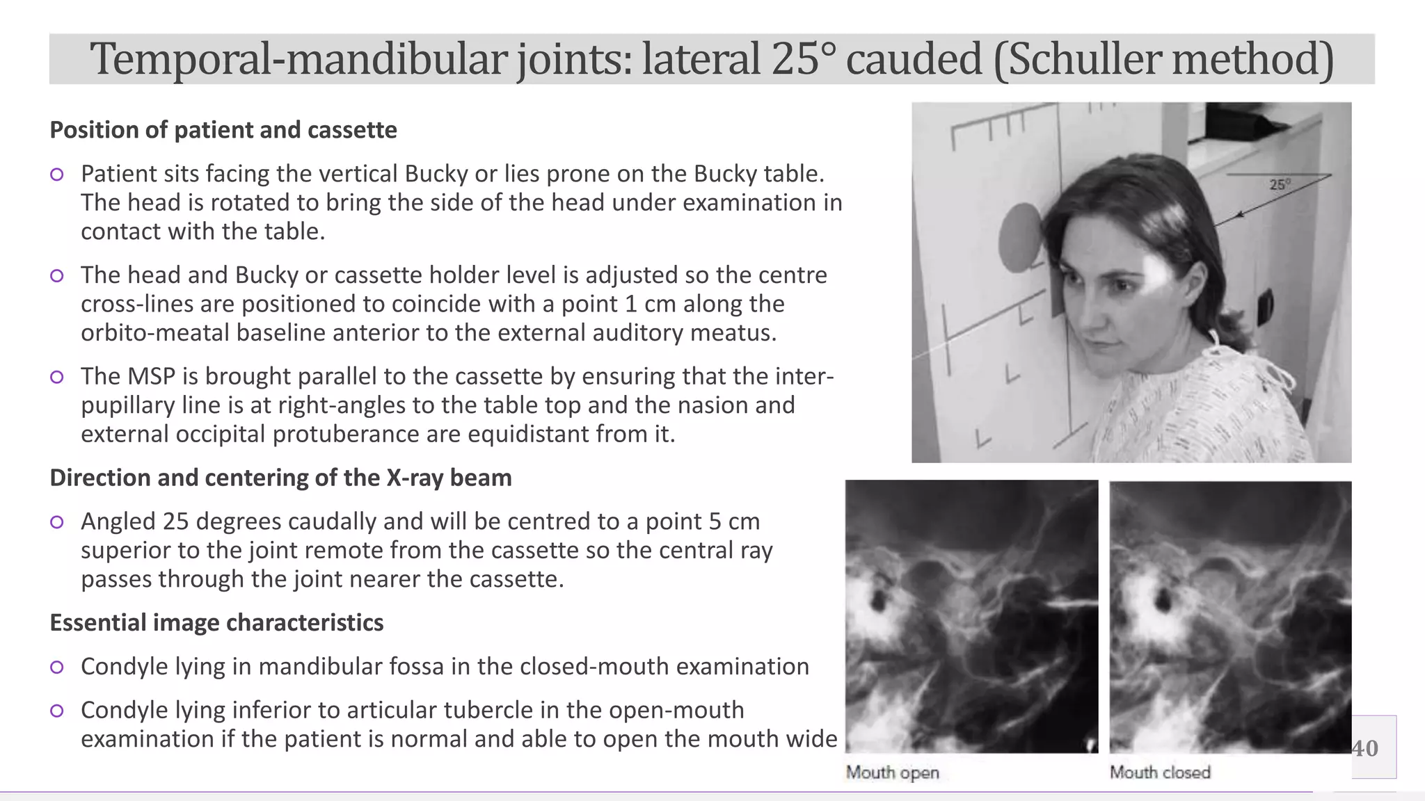Contoso Ltd.
Position of patient and cassette
○ Patient sits facing the vertical Bucky or lies prone on the Bucky table.
The head is rotated to bring the side of the head under examination in
contact with the table.
○ The head and Bucky or cassette holder level is adjusted so the centre
cross-lines are positioned to coincide with a point 1 cm along the
orbito-meatal baseline anterior to the external auditory meatus.
○ The MSP is brought parallel to the cassette by ensuring that the inter-
pupillary line is at right-angles to the table top and the nasion and
external occipital protuberance are equidistant from it.
Direction and centering of the X-ray beam
○ Angled 25 degrees caudally and will be centred to a point 5 cm
superior to the joint remote from the cassette so the central ray
passes through the joint nearer the cassette.
Essential image characteristics
○ Condyle lying in mandibular fossa in the closed-mouth examination
○ Condyle lying inferior to articular tubercle in the open-mouth
examination if the patient is normal and able to open the mouth wide 40
Temporal-mandibularjoints:lateral 25° cauded(Schuller method)
 