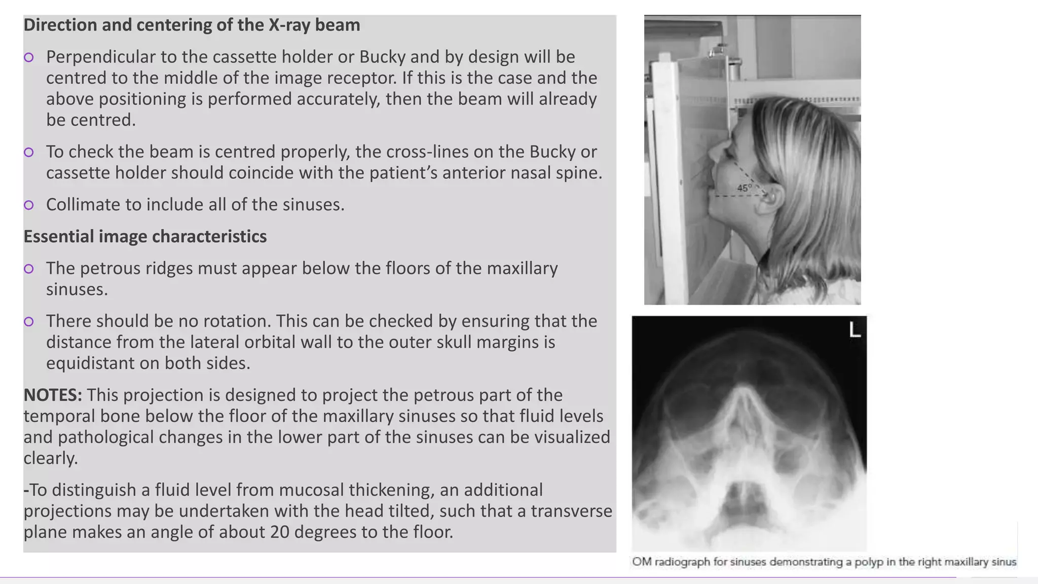 Contoso Ltd.
Direction and centering of the X-ray beam
○ Perpendicular to the cassette holder or Bucky and by design will be
centred to the middle of the image receptor. If this is the case and the
above positioning is performed accurately, then the beam will already
be centred.
○ To check the beam is centred properly, the cross-lines on the Bucky or
cassette holder should coincide with the patient’s anterior nasal spine.
○ Collimate to include all of the sinuses.
Essential image characteristics
○ The petrous ridges must appear below the floors of the maxillary
sinuses.
○ There should be no rotation. This can be checked by ensuring that the
distance from the lateral orbital wall to the outer skull margins is
equidistant on both sides.
NOTES: This projection is designed to project the petrous part of the
temporal bone below the floor of the maxillary sinuses so that fluid levels
and pathological changes in the lower part of the sinuses can be visualized
clearly.
-To distinguish a fluid level from mucosal thickening, an additional
projections may be undertaken with the head tilted, such that a transverse
plane makes an angle of about 20 degrees to the floor.
42
Add a footer
 