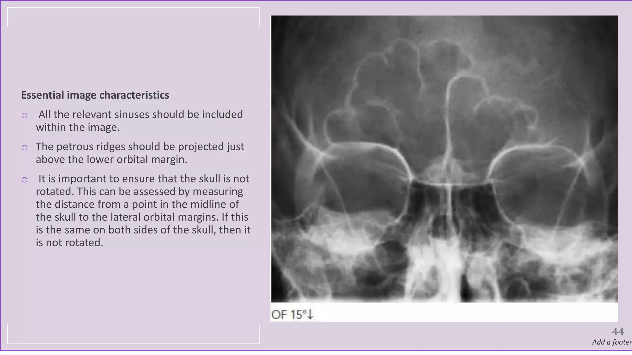 Essential image characteristics
o All the relevant sinuses should be included
within the image.
o The petrous ridges should be projected just
above the lower orbital margin.
o It is important to ensure that the skull is not
rotated. This can be assessed by measuring
the distance from a point in the midline of
the skull to the lateral orbital margins. If this
is the same on both sides of the skull, then it
is not rotated.
Add a footer
44
 
