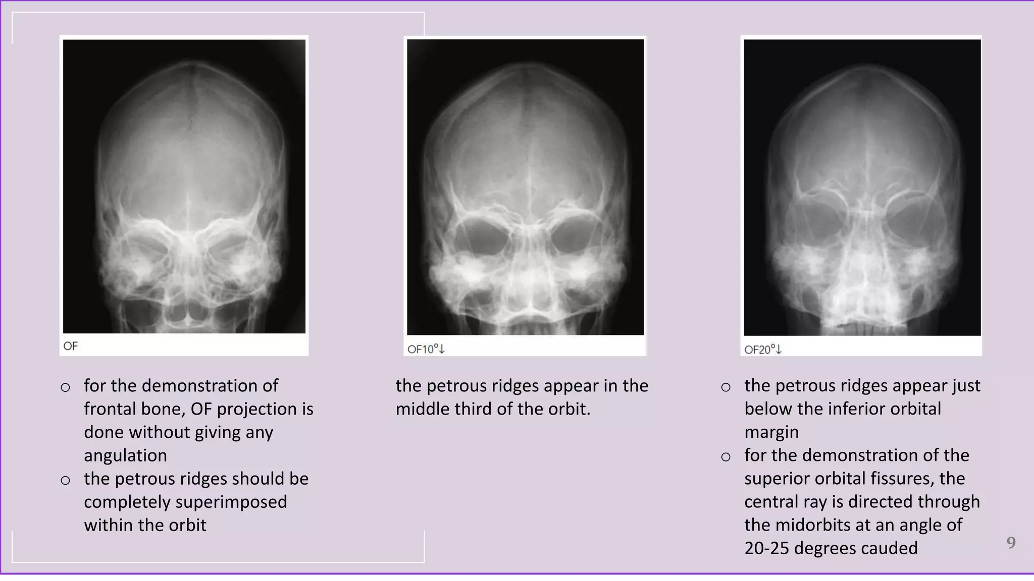 9
o for the demonstration of
frontal bone, OF projection is
done without giving any
angulation
o the petrous ridges should be
completely superimposed
within the orbit
the petrous ridges appear in the
middle third of the orbit.
o the petrous ridges appear just
below the inferior orbital
margin
o for the demonstration of the
superior orbital fissures, the
central ray is directed through
the midorbits at an angle of
20-25 degrees cauded
 