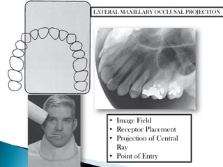 LATERAL MAXILLARY OCCLUSAL PROJECTION




    • Image Field
    • Receptor Placement
    • Projection of Central
      Ray
    • Point of Entry
 
