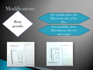 For maxilla, place the
          film on far side of the
 Bony              film.
growths    For mandible, place
           film between the tori
                and tongue
 