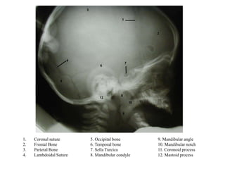 1. Coronal suture 5. Occipital bone 9. Mandibular angle
2. Frontal Bone 6. Temporal bone 10. Mandibular notch
3. Parietal Bone 7. Sella Turcica 11. Coronoid process
4. Lambdoidal Suture 8. Mandibular condyle 12. Mastoid process
 