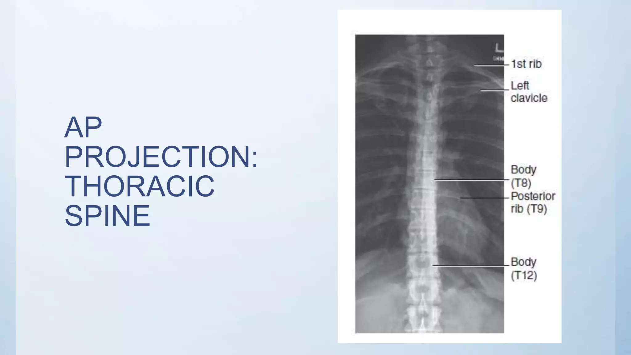 AP
PROJECTION:
THORACIC
SPINE
 