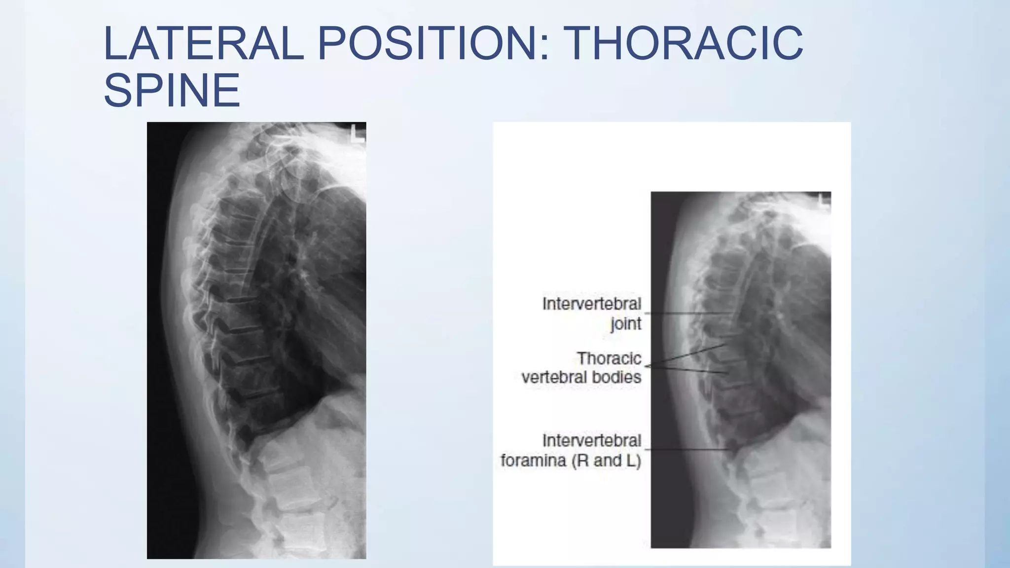 LATERAL POSITION: THORACIC
SPINE
 