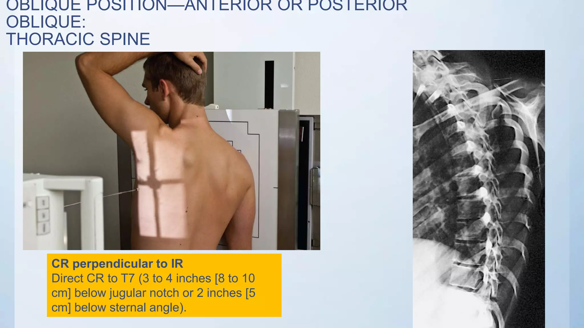 OBLIQUE POSITION—ANTERIOR OR POSTERIOR
OBLIQUE:
THORACIC SPINE
CR perpendicular to IR
Direct CR to T7 (3 to 4 inches [8 to 10
cm] below jugular notch or 2 inches [5
cm] below sternal angle).
 
