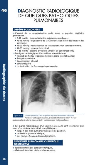 Radiographie thoracique du livre manuel pratique d'anesthésie | PDF