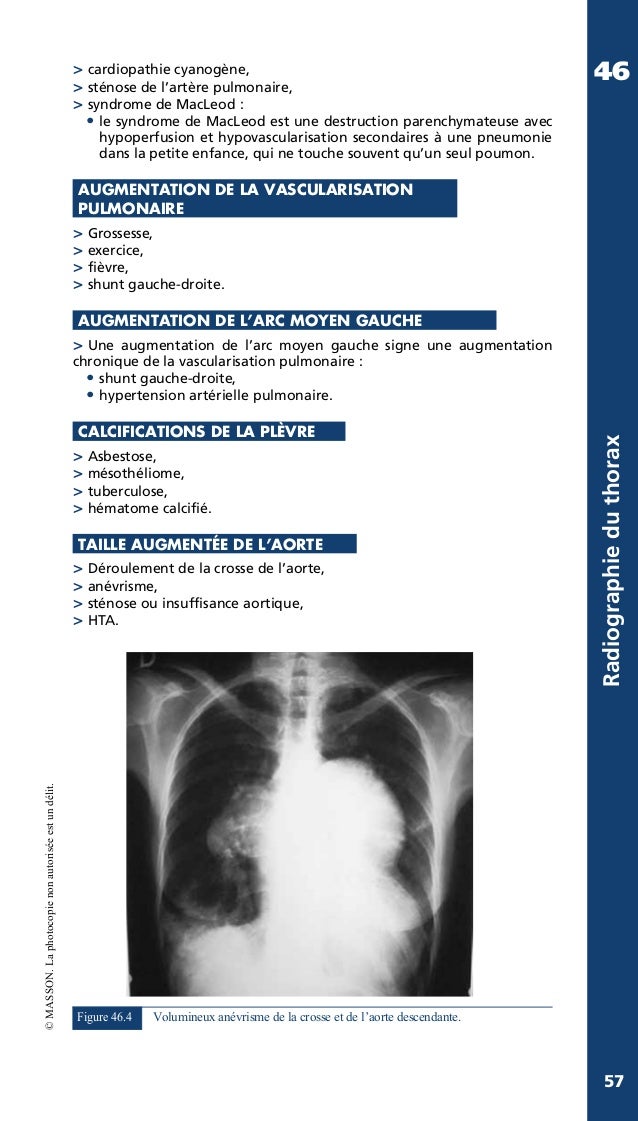 Radiographie thoracique du livre manuel pratique d'anesthésie Radiographie thoracique du livre manuel pratique d'anesthésie