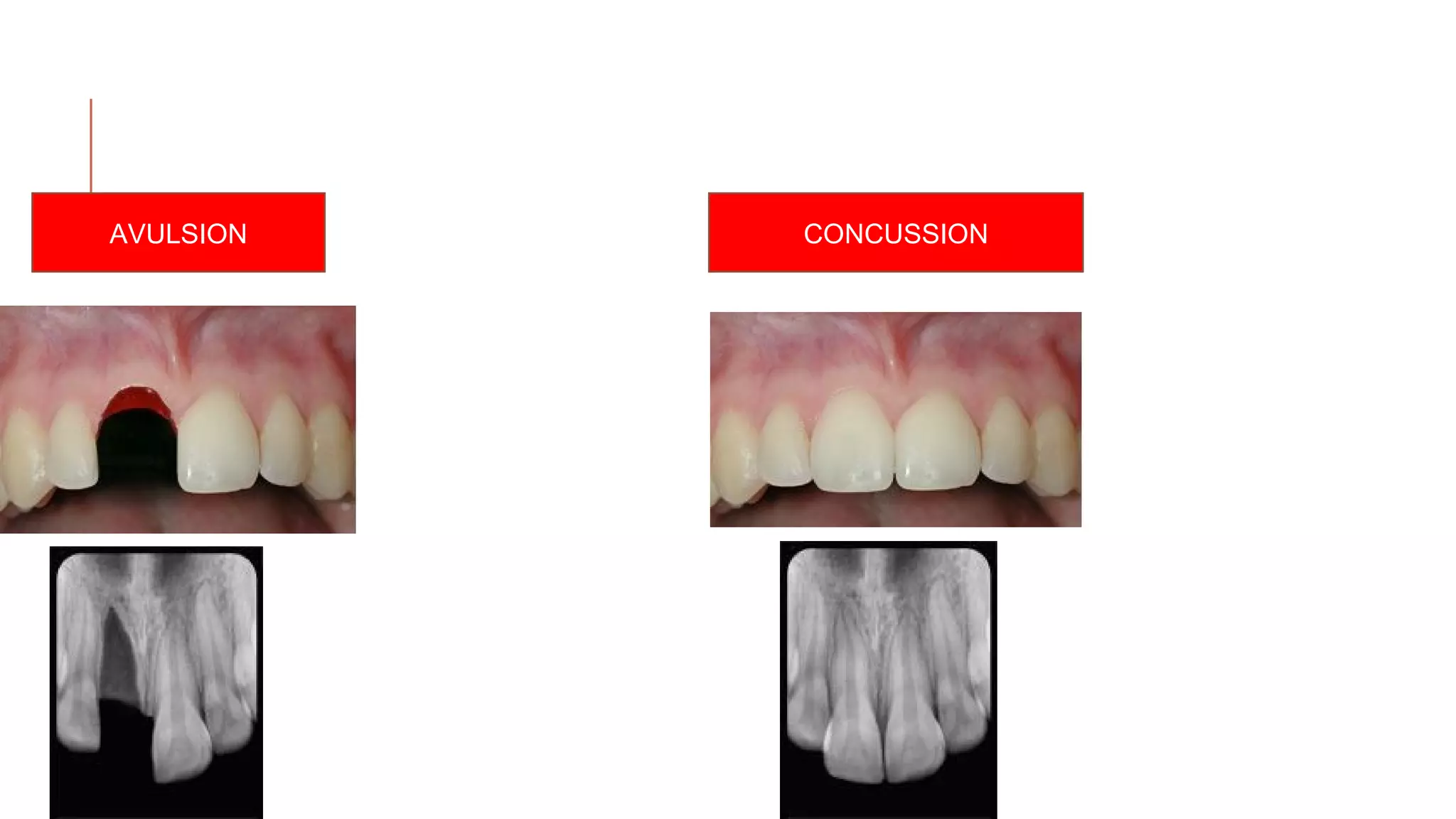 Radiographs in endodontic diagnosis PPT