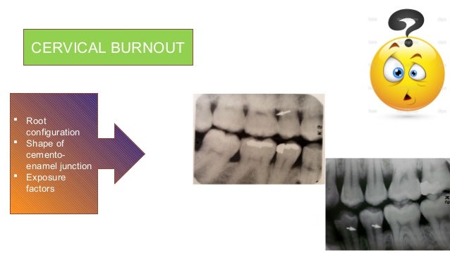 Mach Band Effect In Dentistry