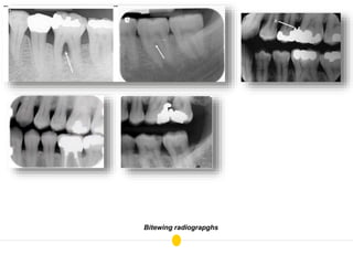 Pan Bitewing Radiograph Radiographs in Operative | PPTX