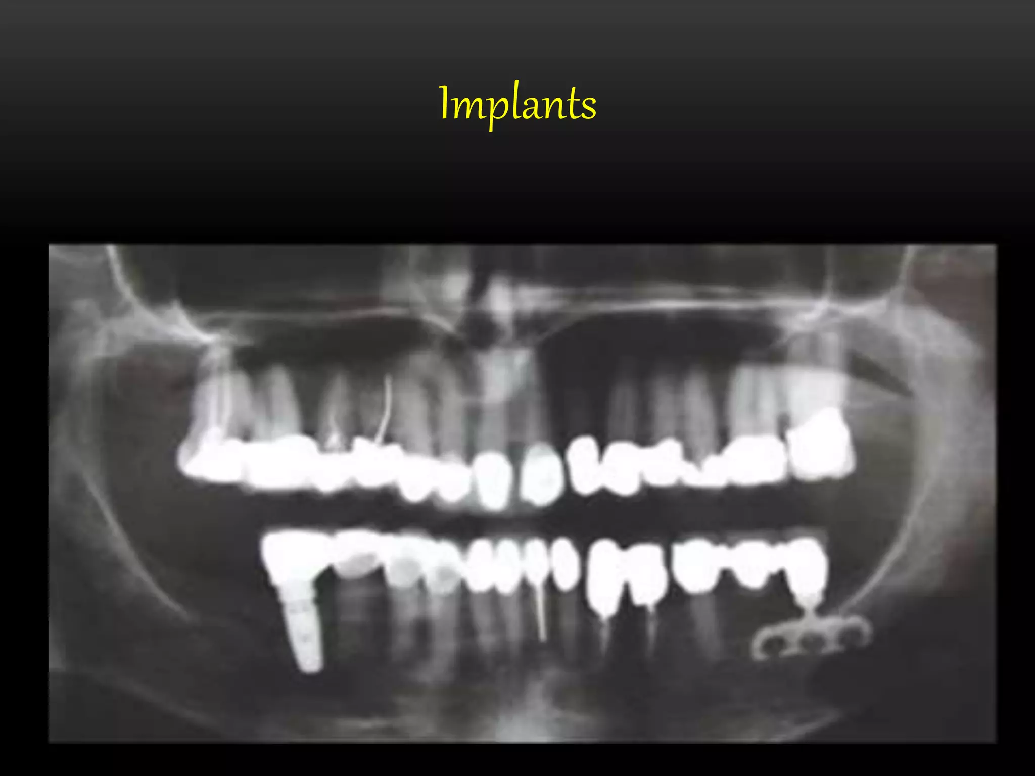 OPG and Extraoral radiography PPT