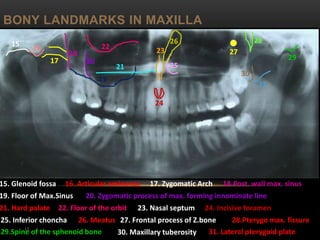 BONY LANDMARKS IN MAXILLA
15
15
15. Glenoid fossa
19. Floor of Max.Sinus
17. Zygomatic Arch16. Articular eminence 18.Post. wall max. sinus
20. Zygomatic process of max. forming innominate line
21. Hard palate 22. Floor of the orbit 23. Nasal septum 24. Incisive foramen
25. Inferior choncha 26. Meatus 27. Frontal process of Z.bone
16
17
18
19
20
21
22
23
29
25
24
26
28.Pterygo max. fissure
30. Maxillary tuberosity29.Spine of the sphenoid bone 31. Lateral pterygoid plate
31
30
28
27
 