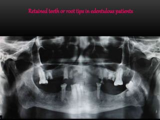 Retainedteethor root tips in edentulous patients
 