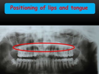 Positioning of lips and tongue
 