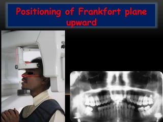 Positioning of Frankfort plane
upward
 