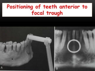 Positioning of teeth anterior to
focal trough
 