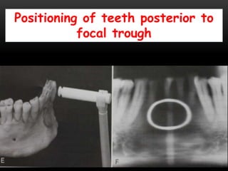 Positioning of teeth posterior to
focal trough
 