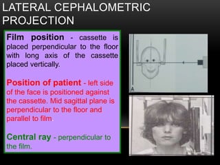 LATERAL CEPHALOMETRIC
PROJECTION
Film position - cassette is
placed perpendicular to the floor
with long axis of the cassette
placed vertically.
Position of patient - left side
of the face is positioned against
the cassette. Mid sagittal plane is
perpendicular to the floor and
parallel to film.
Central ray - perpendicular to
the film.
 