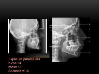 Exposure parameters
KVp= 84
mAs= 13
Seconds =1.6
 