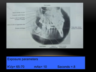 Exposure parameters
KVp= 65-70 mAs= 10 Seconds =.8
 