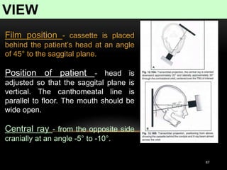 VIEW
67
Film position - cassette is placed
behind the patient’s head at an angle
of 45° to the saggital plane.
Position of patient - head is
adjusted so that the saggital plane is
vertical. The canthomeatal line is
parallel to floor. The mouth should be
wide open.
Central ray - from the opposite side
cranially at an angle -5° to -10°.
 
