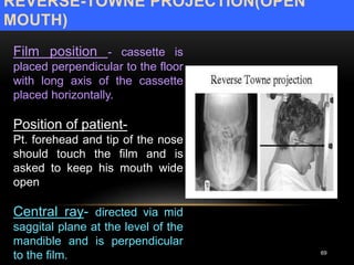 REVERSE-TOWNE PROJECTION(OPEN
MOUTH)
69
Film position - cassette is
placed perpendicular to the floor
with long axis of the cassette
placed horizontally.
Position of patient-
Pt. forehead and tip of the nose
should touch the film and is
asked to keep his mouth wide
open
Central ray- directed via mid
saggital plane at the level of the
mandible and is perpendicular
to the film.
 
