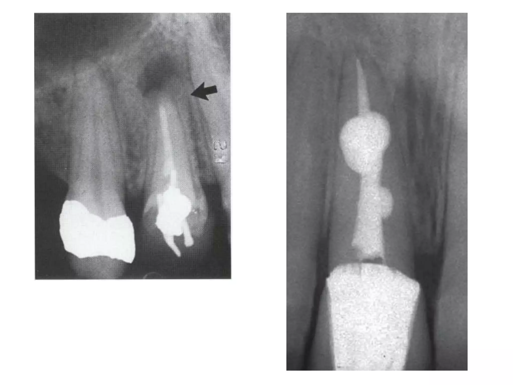 Visualization Endogram Radiographs in endodontics | PDF