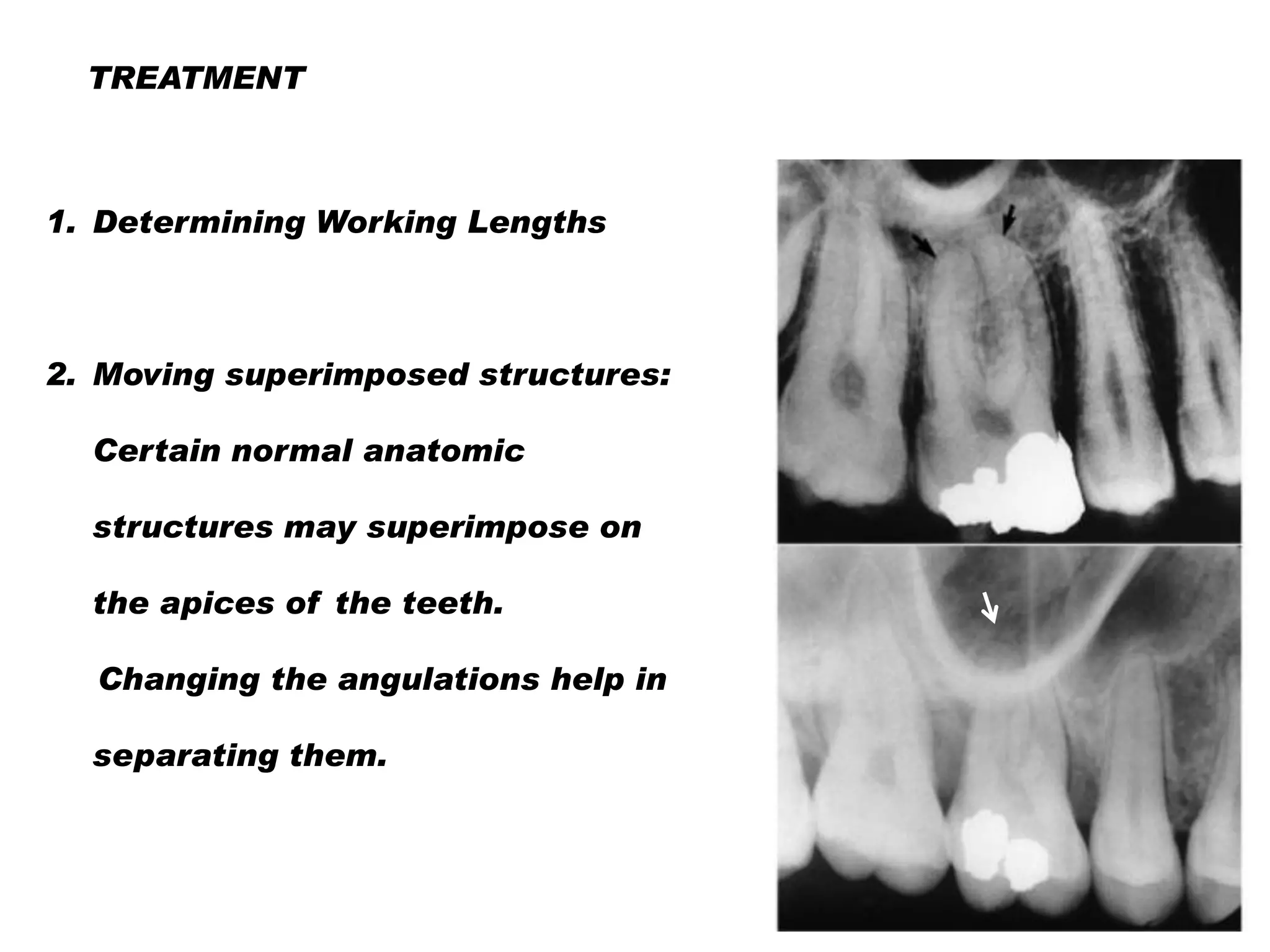 Endo Short Working Length Radiograph Radiographs in endodontics | PDF