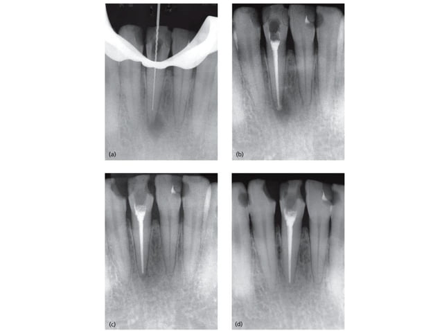 Endo Short Working Length Radiograph Radiographs in endodontics | PPT
