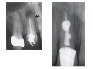 Radiographs in endodontics